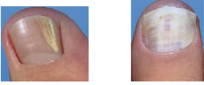 nagelsvamp snabb behandling nagelsvamp snabb behandling