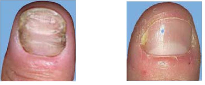 hur botar man nagelsvamp hur botar man nagelsvamp
