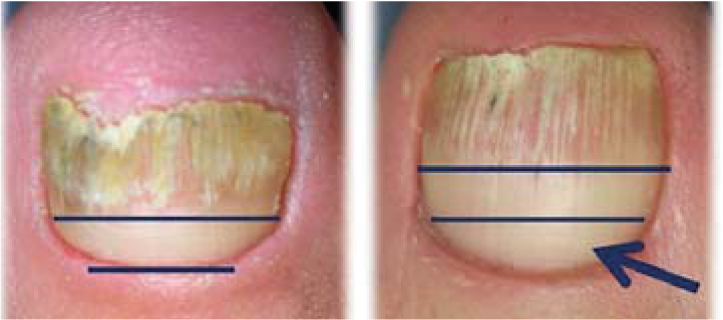 bota nagelsvamp snabbt bota nagelsvamp snabbt